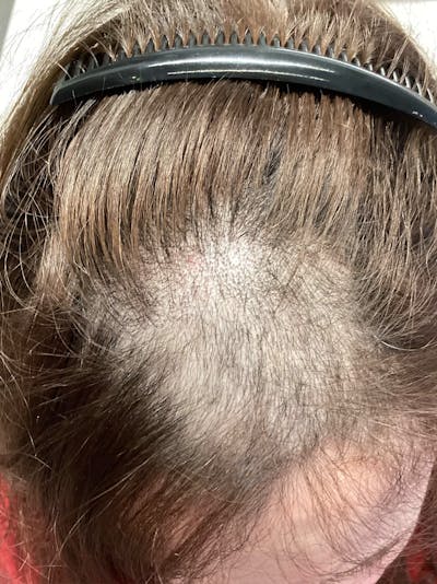 LaserCap HD+ Before & After Gallery - Patient 707705 - Image 1