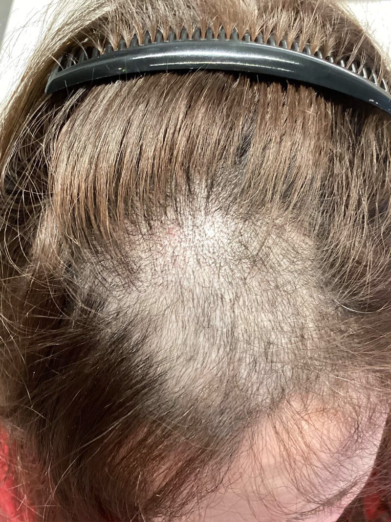 Telogen Effluvium Before & After Gallery - Patient 541558 - Image 1