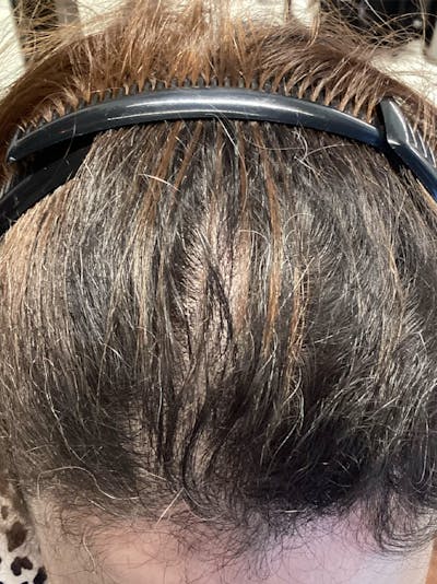 LaserCap HD+ Before & After Gallery - Patient 707705 - Image 2