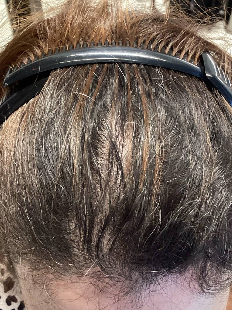 Telogen Effluvium Before & After Gallery - Patient 541558 - Image 2