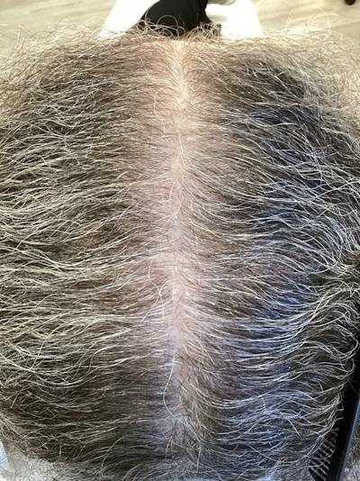 Androgenic Alopecia Before & After Gallery - Patient 388565 - Image 1