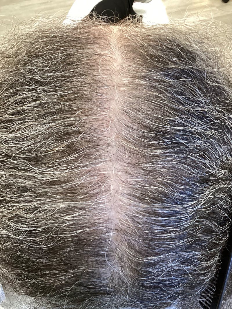 Androgenic Alopecia Before & After Gallery - Patient 388565 - Image 1
