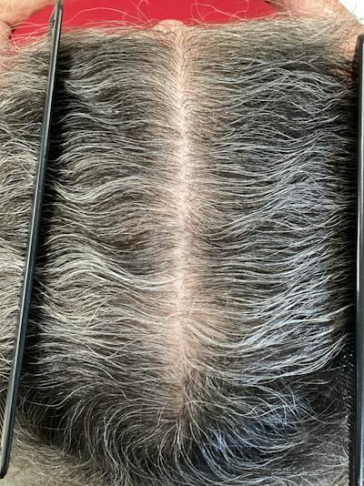 Androgenic Alopecia Before & After Gallery - Patient 388565 - Image 2