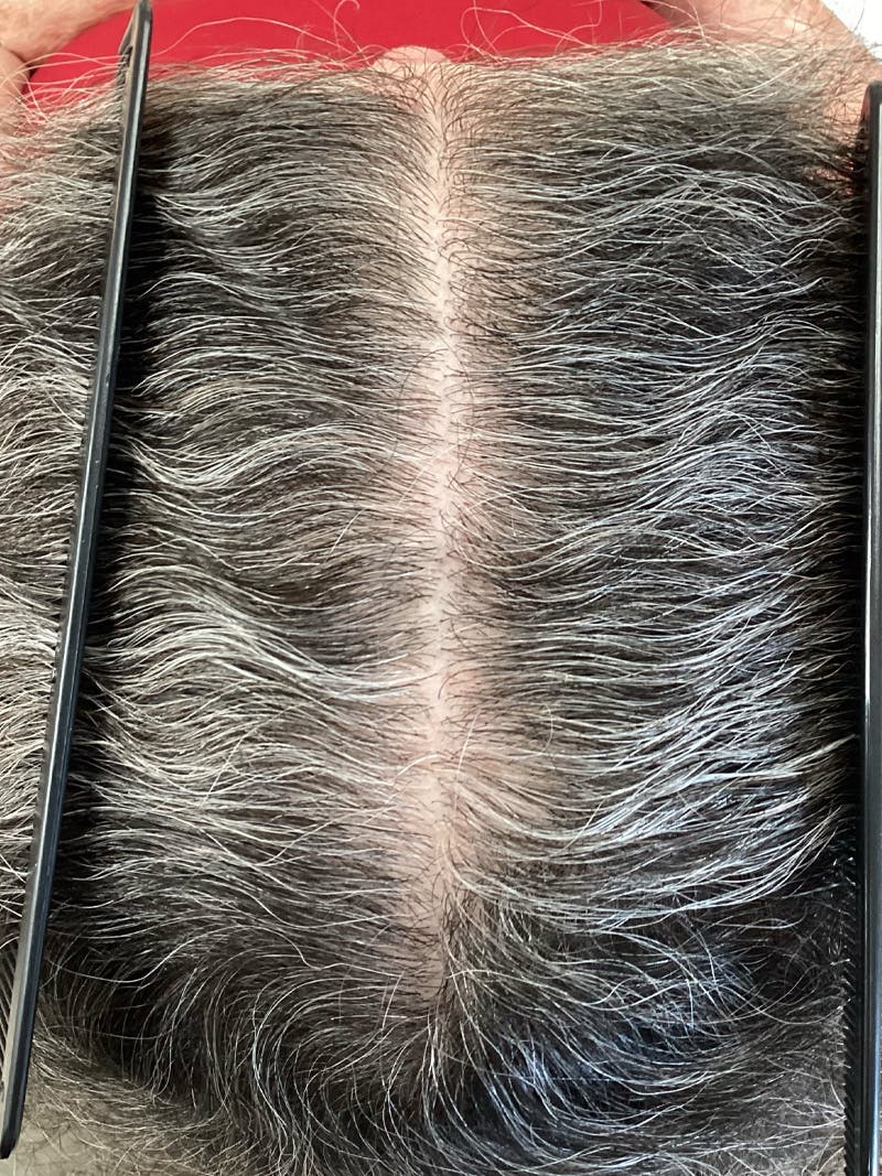 Androgenic Alopecia Before & After Gallery - Patient 388565 - Image 2