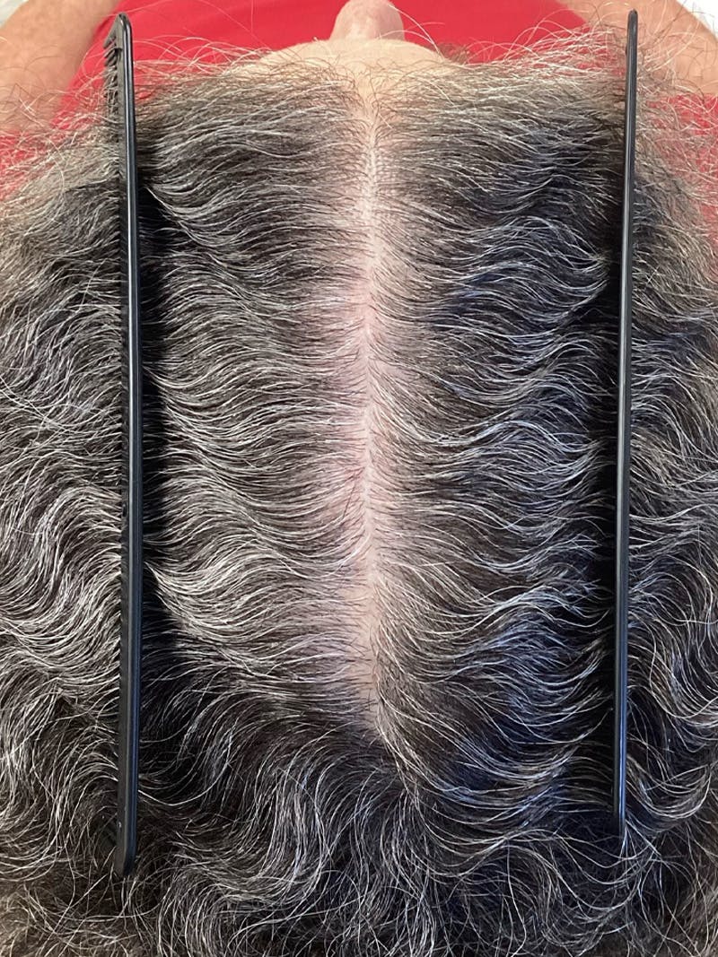 Androgenic Alopecia Before & After Gallery - Patient 388565 - Image 4