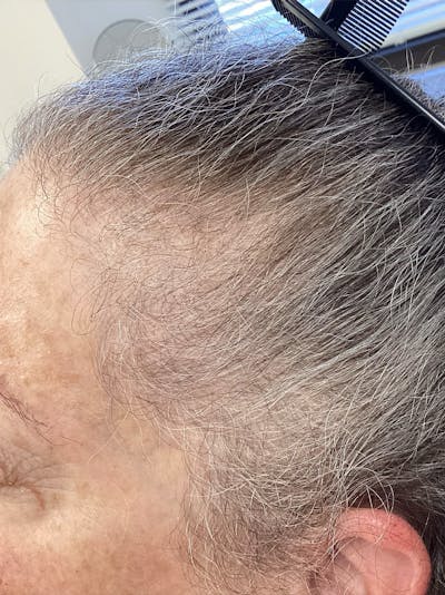 Androgenic Alopecia Before & After Gallery - Patient 169834 - Image 1