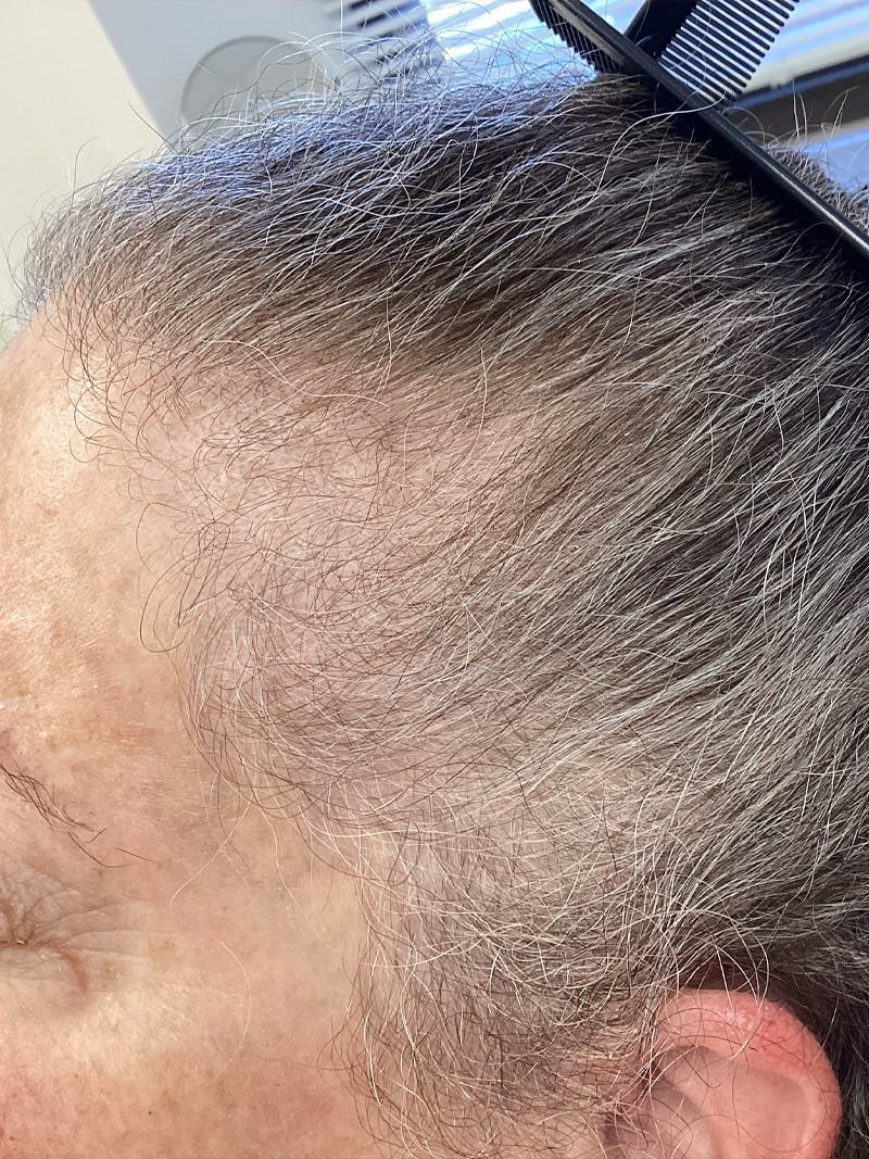 Androgenic Alopecia Before & After Gallery - Patient 169834 - Image 1