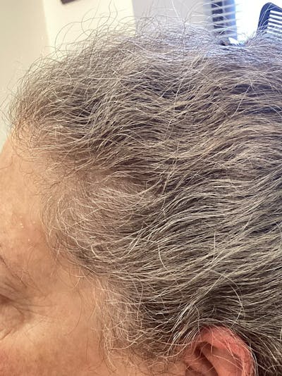 Androgenic Alopecia Before & After Gallery - Patient 169834 - Image 2