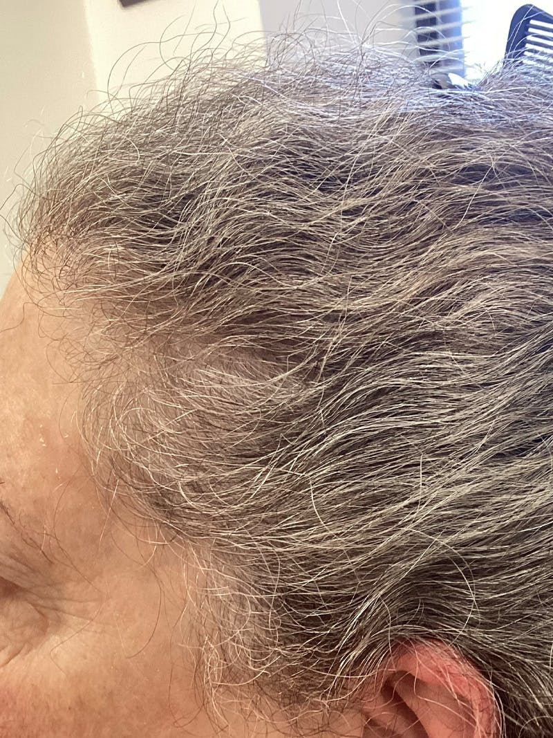 Androgenic Alopecia Before & After Gallery - Patient 169834 - Image 2