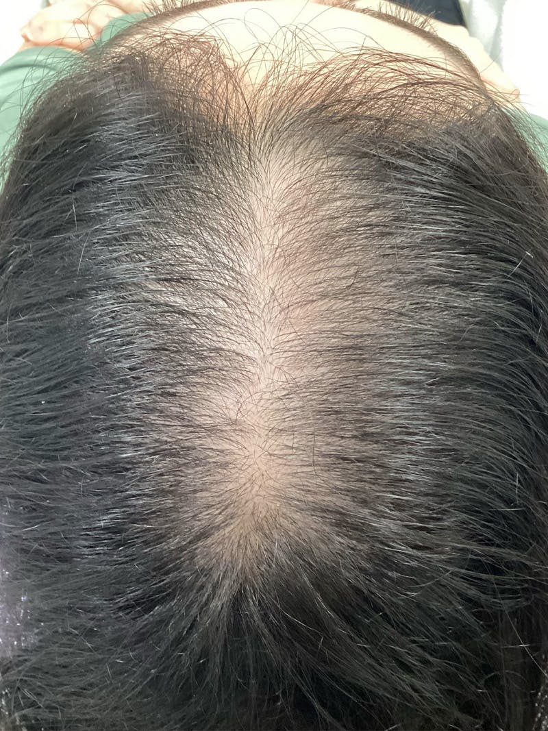 Androgenic Alopecia Before & After Gallery - Patient 145715 - Image 1