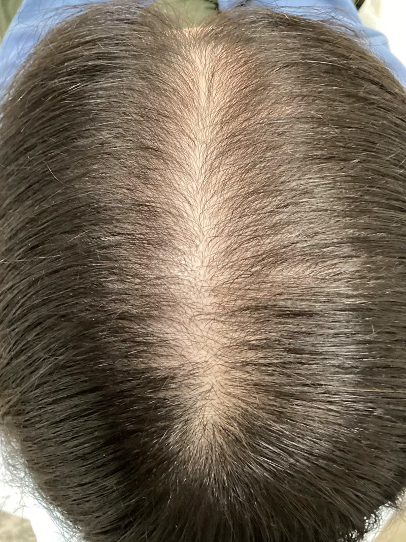 Androgenic Alopecia Before & After Gallery - Patient 145715 - Image 3