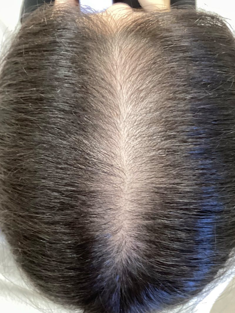 Androgenic Alopecia Before & After Gallery - Patient 145715 - Image 4