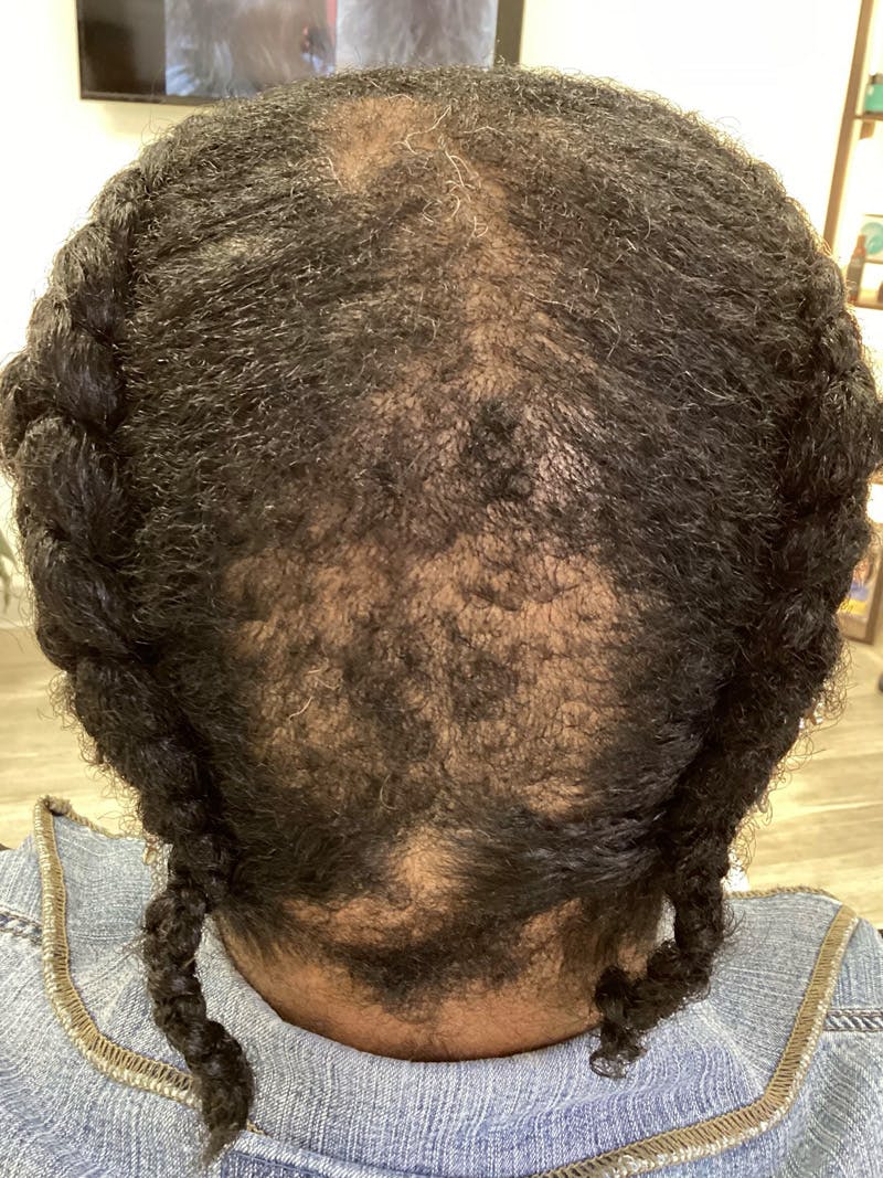 Scarring Alopecia Before & After Gallery - Patient 370113 - Image 1
