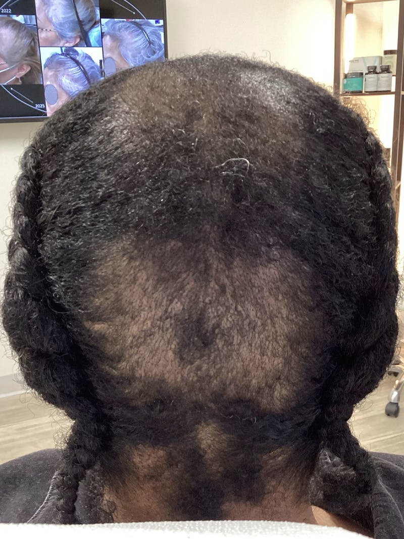 Scarring Alopecia Before & After Gallery - Patient 370113 - Image 2