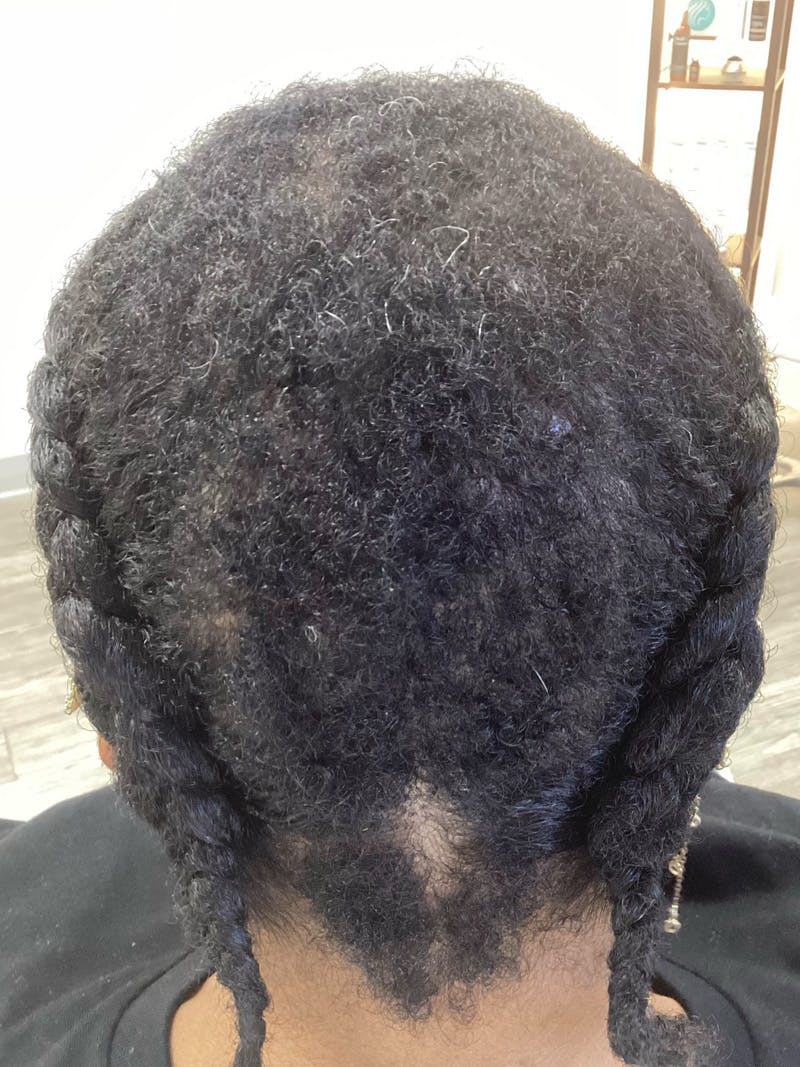 Scarring Alopecia Before & After Gallery - Patient 370113 - Image 4