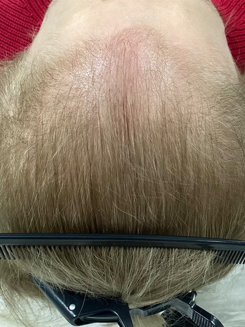 Androgenic Alopecia Before & After Gallery - Patient 367727 - Image 1