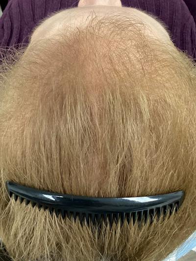 Androgenic Alopecia Before & After Gallery - Patient 367727 - Image 2