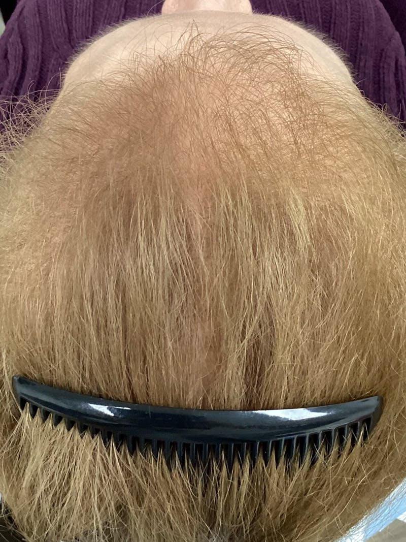 Androgenic Alopecia Before & After Gallery - Patient 367727 - Image 2