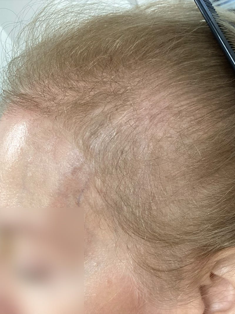 Androgenic Alopecia Before & After Gallery - Patient 372611 - Image 1
