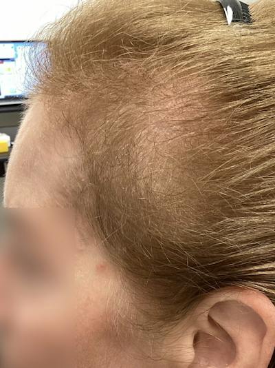 Androgenic Alopecia Before & After Gallery - Patient 372611 - Image 2
