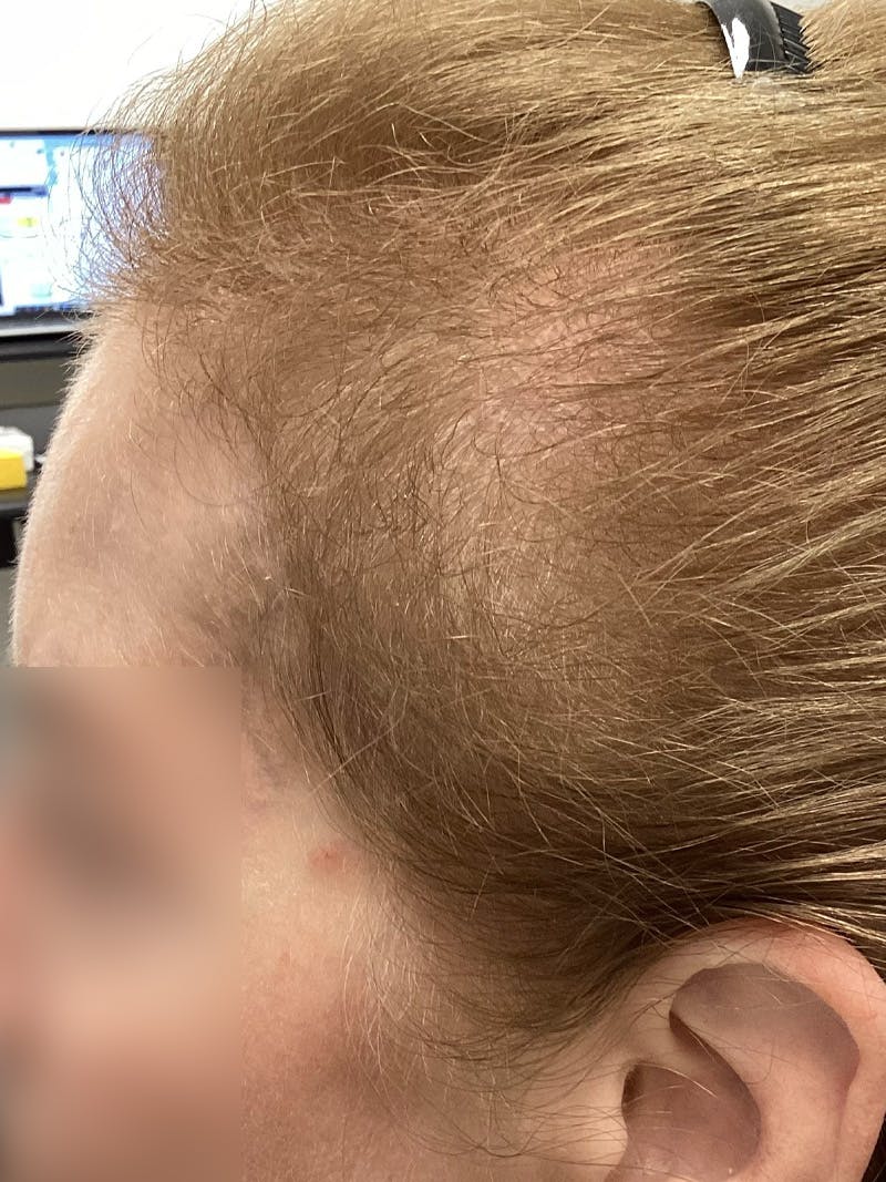 Androgenic Alopecia Before & After Gallery - Patient 372611 - Image 2