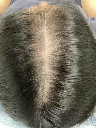 Androgenic Alopecia Before & After Gallery - Patient 387642 - Image 1