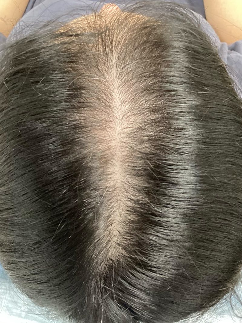 Androgenic Alopecia Before & After Gallery - Patient 387642 - Image 1