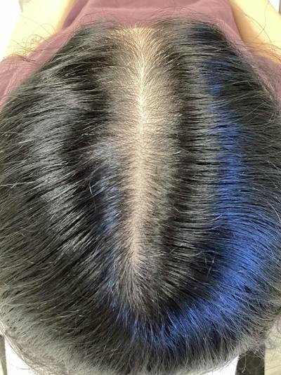 Androgenic Alopecia Before & After Gallery - Patient 387642 - Image 2