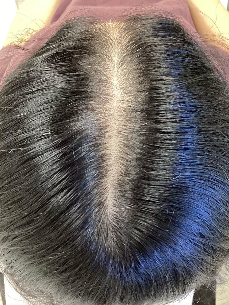 Androgenic Alopecia Before & After Gallery - Patient 387642 - Image 2