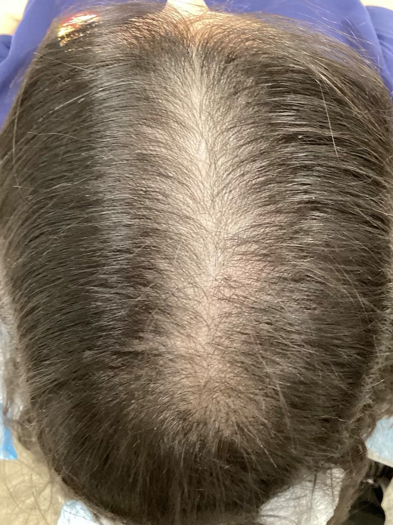 Androgenic Alopecia Before & After Gallery - Patient 869474 - Image 1