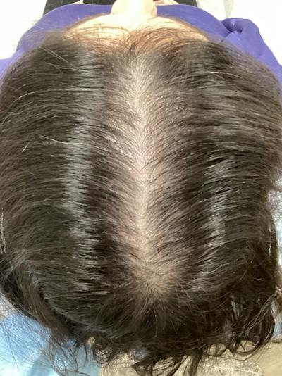 Androgenic Alopecia Before & After Gallery - Patient 869474 - Image 2
