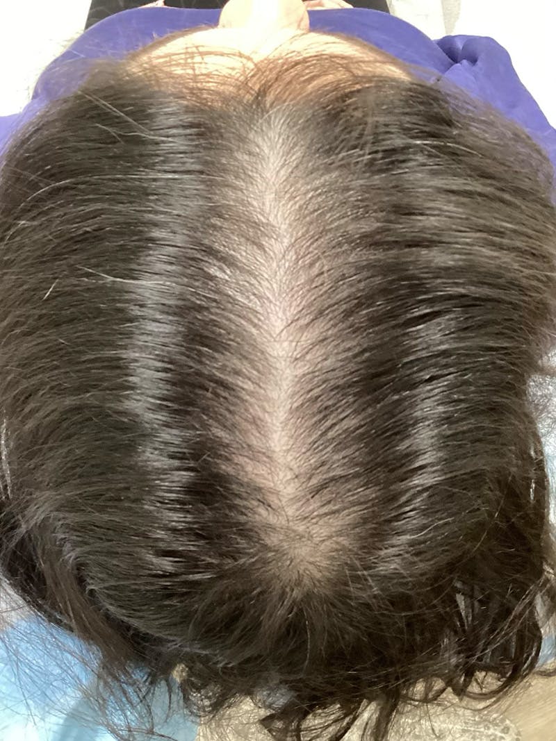 Androgenic Alopecia Before & After Gallery - Patient 869474 - Image 2