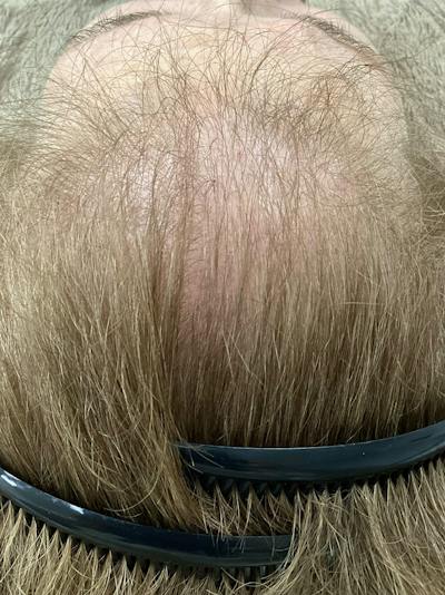 Androgenic Alopecia Before & After Gallery - Patient 338906 - Image 1