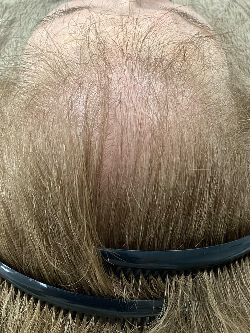 Androgenic Alopecia Before & After Gallery - Patient 338906 - Image 1