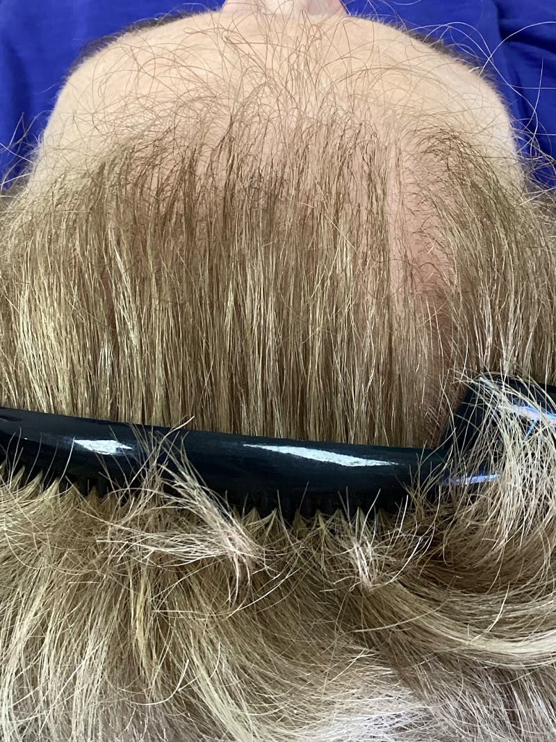 Androgenic Alopecia Before & After Gallery - Patient 338906 - Image 2