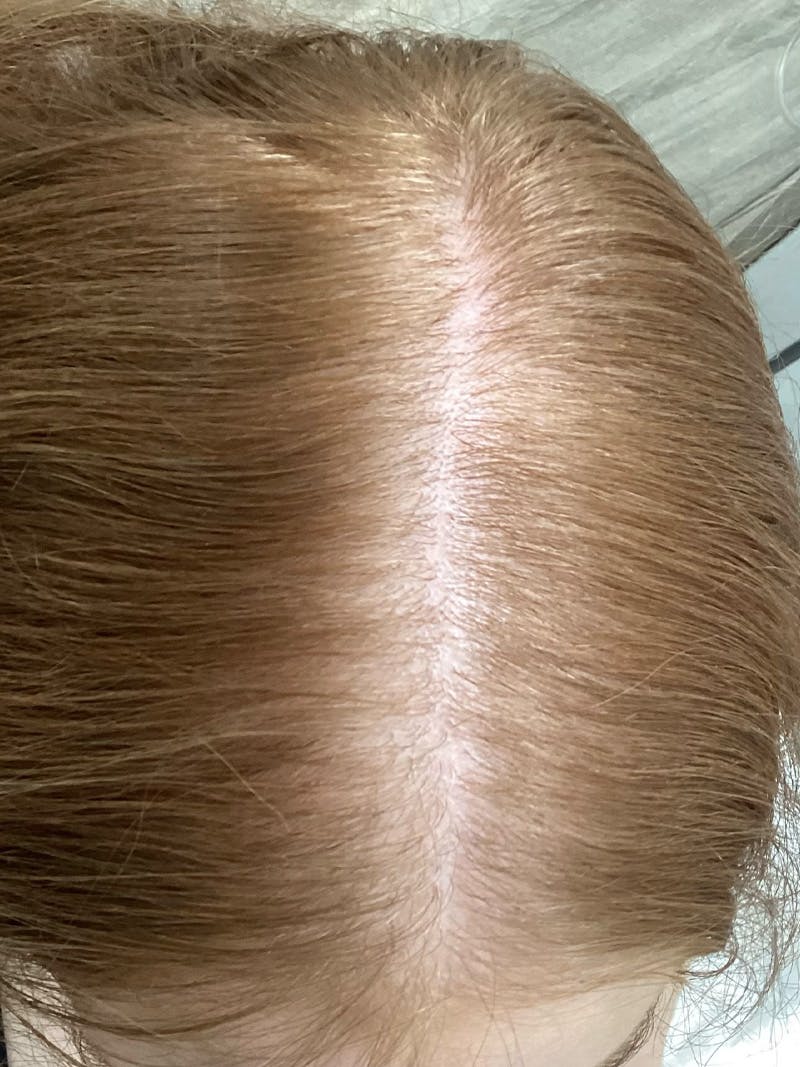 Androgenic Alopecia Before & After Gallery - Patient 244524 - Image 2