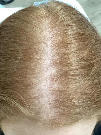 Androgenic Alopecia Before & After Gallery - Patient 244524 - Image 1