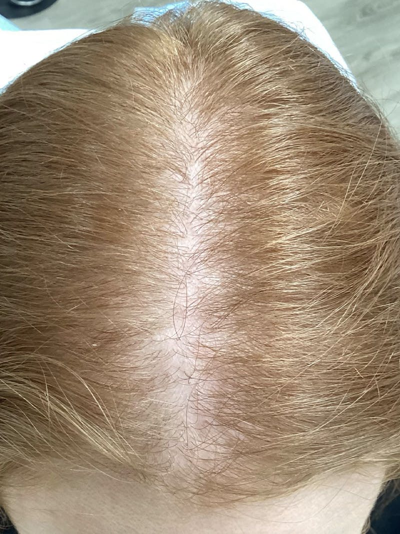 Androgenic Alopecia Before & After Gallery - Patient 244524 - Image 1