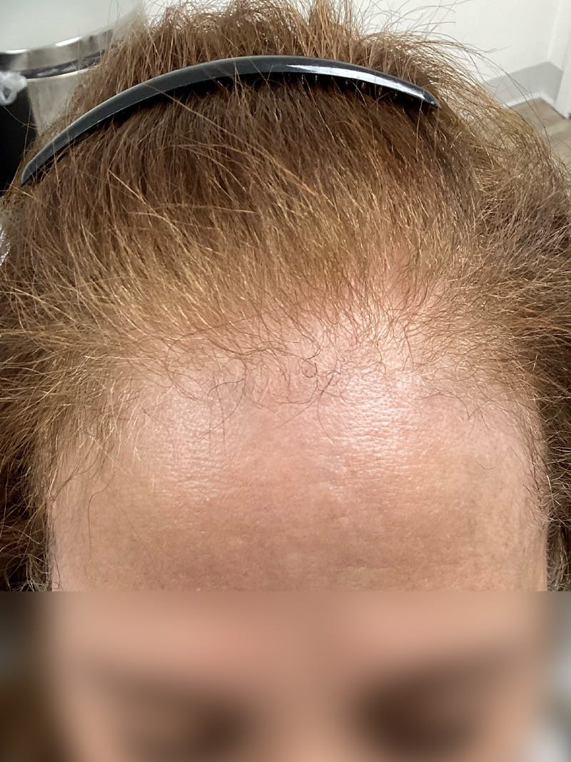 Androgenic Alopecia Before & After Gallery - Patient 262232 - Image 1