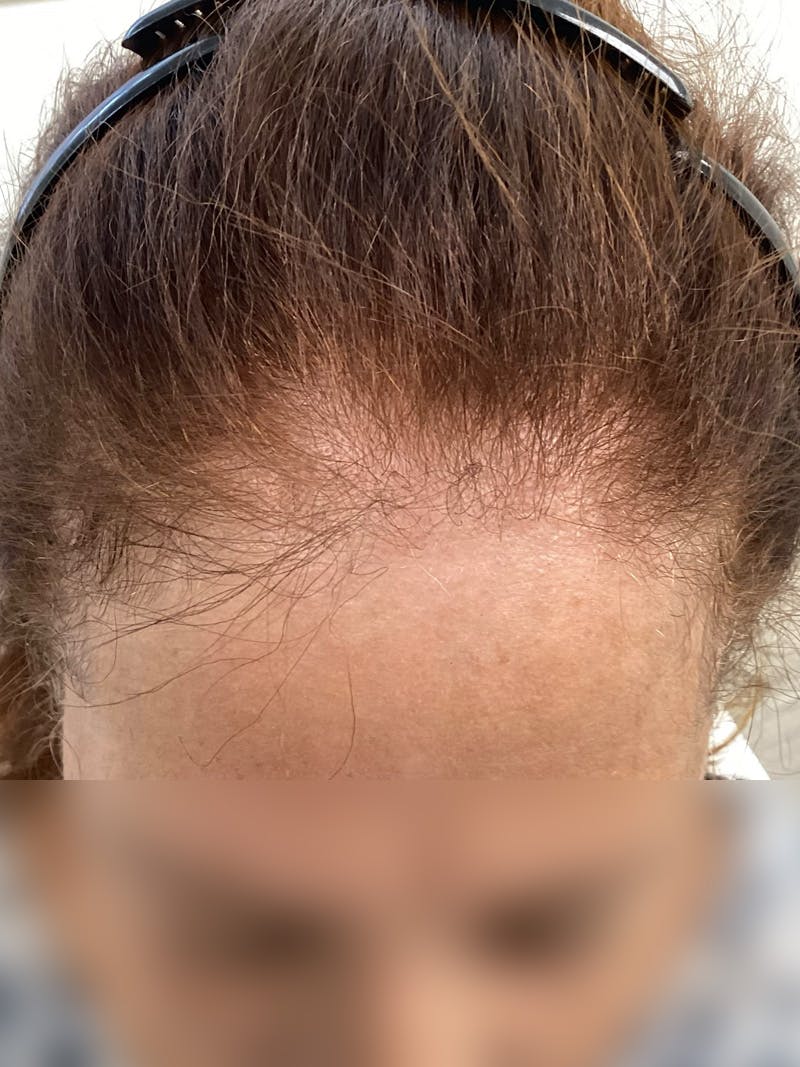 Androgenic Alopecia Before & After Gallery - Patient 262232 - Image 3