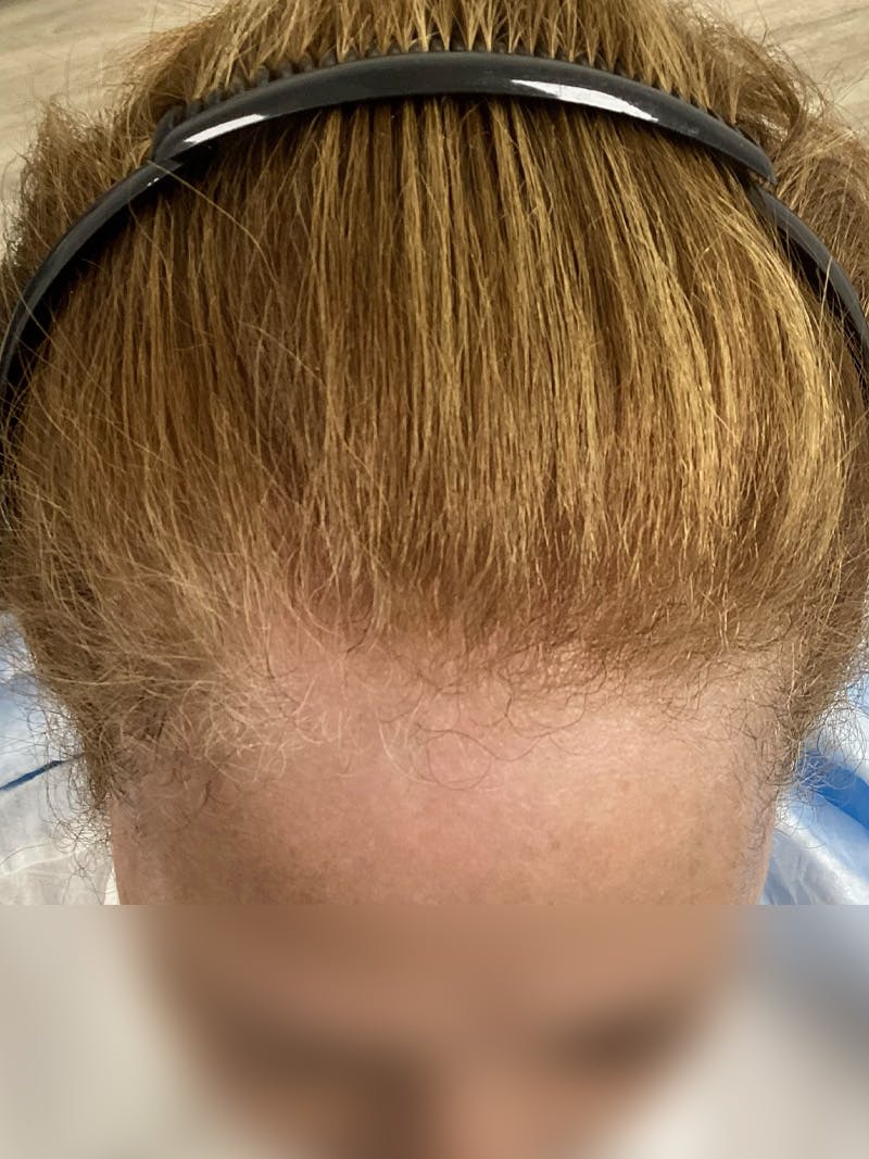 Androgenic Alopecia Before & After Gallery - Patient 262232 - Image 4