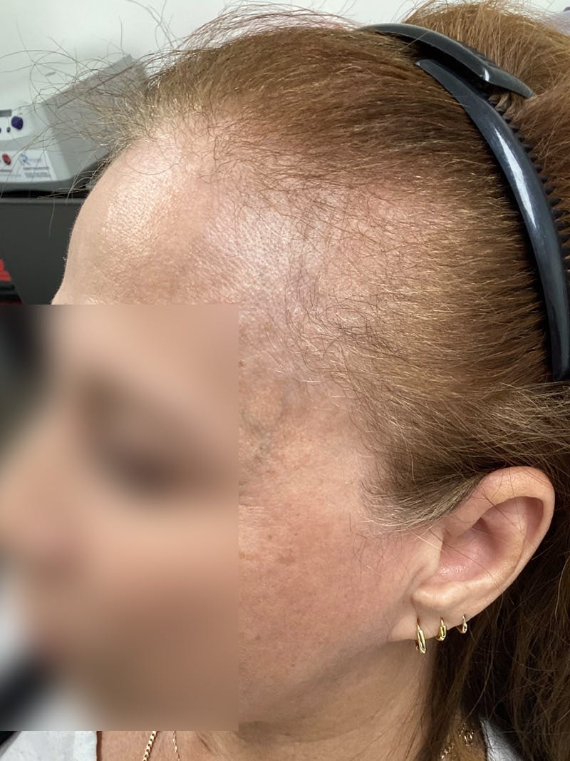 Androgenic Alopecia Before & After Gallery - Patient 143225 - Image 1