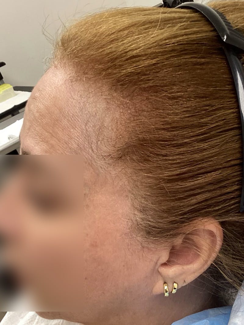 Androgenic Alopecia Before & After Gallery - Patient 143225 - Image 2
