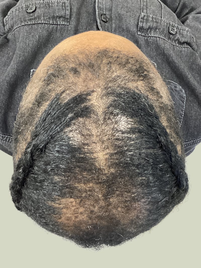 Low Level Laser Therapy Before & After Gallery - Patient 171494 - Image 1