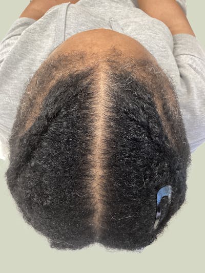 Scarring Alopecia Before & After Gallery - Patient 112226 - Image 2