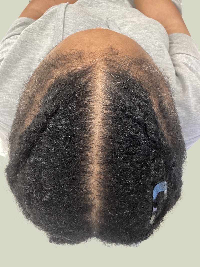 Low Level Laser Therapy Before & After Gallery - Patient 171494 - Image 2