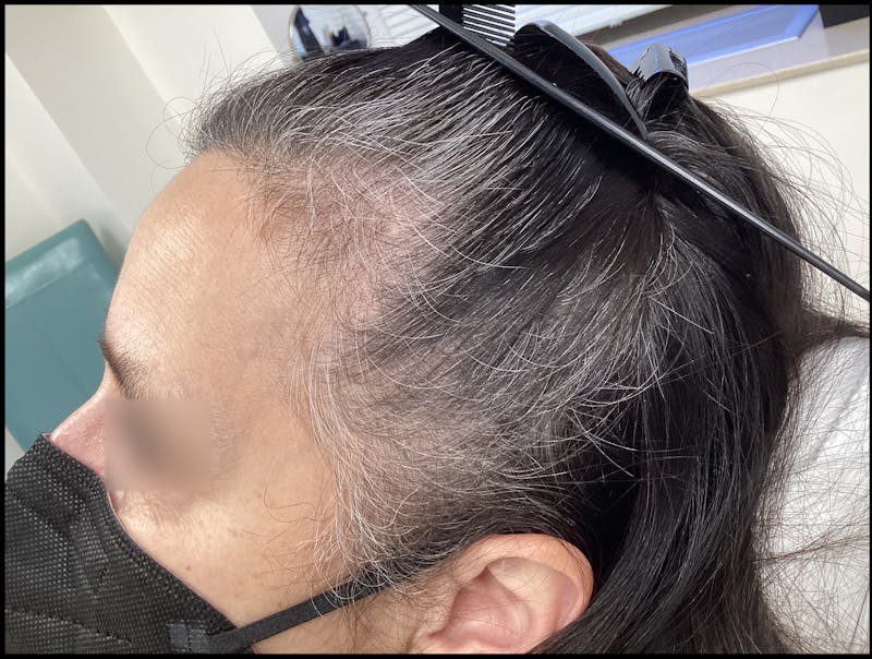 Androgenic Alopecia Before & After Gallery - Patient 412678 - Image 1
