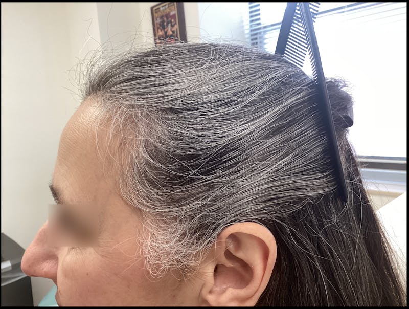 Androgenic Alopecia Before & After Gallery - Patient 412678 - Image 2
