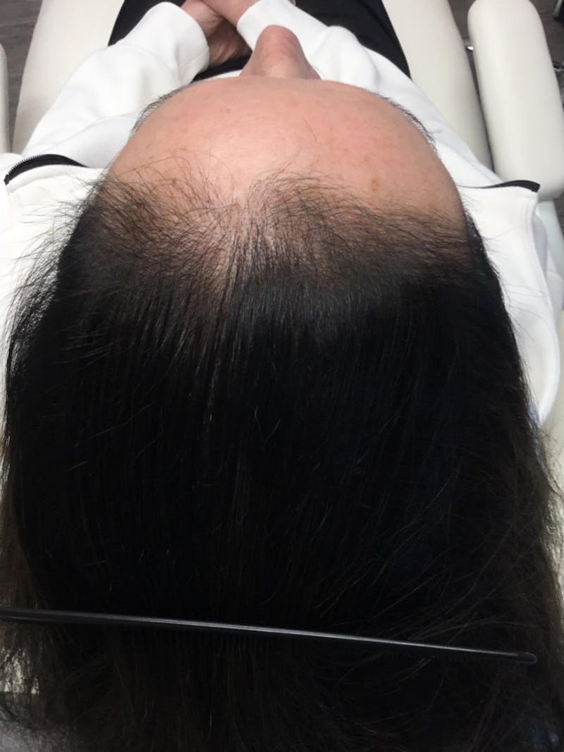 Low Level Laser Therapy Before & After Gallery - Patient 325716 - Image 2