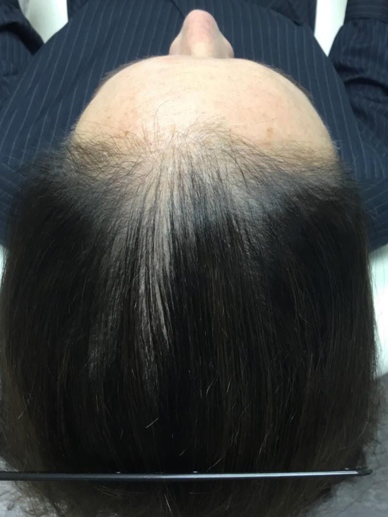 Low Level Laser Therapy Before & After Gallery - Patient 325716 - Image 1